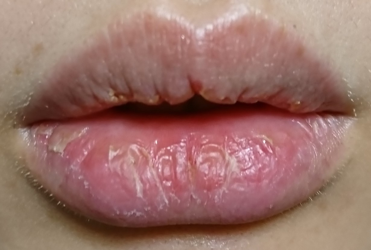 唇炎的症状有哪些 可能是唇炎在作祟 - 学堂在线健康网